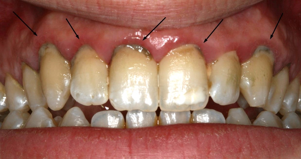 Ουλίτιδα πριν τη θεραπεία