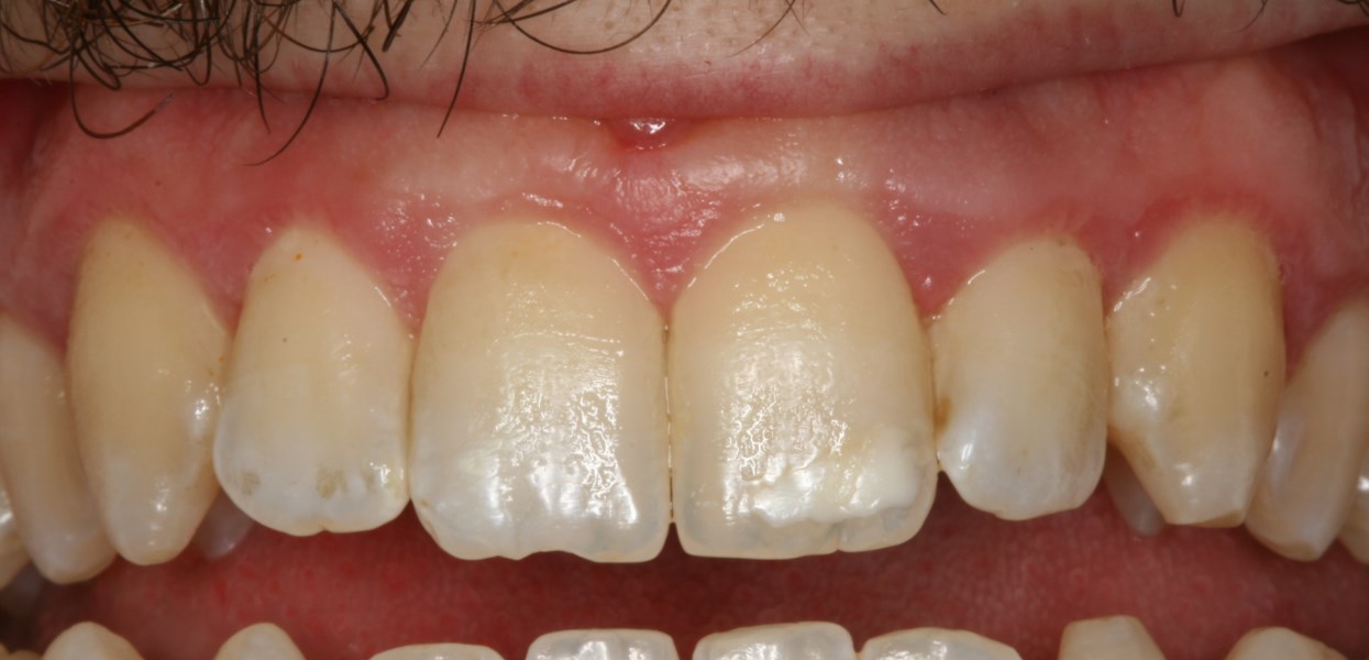 Ουλίτιδα μετά τη θεραπεία