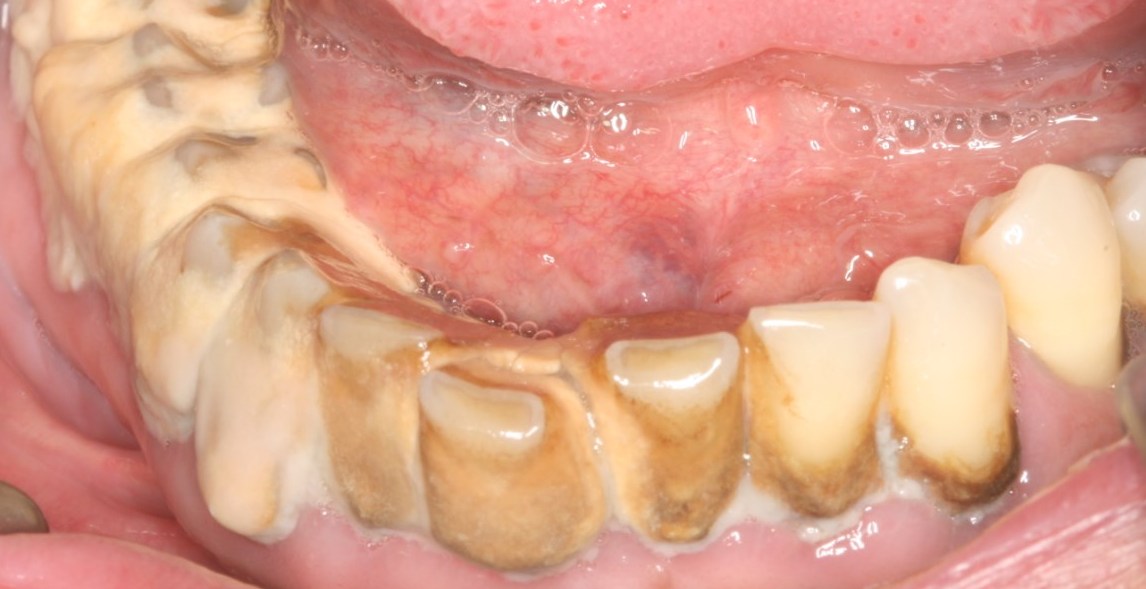 Περιοδοντίτιδα πριν τη θεραπεία