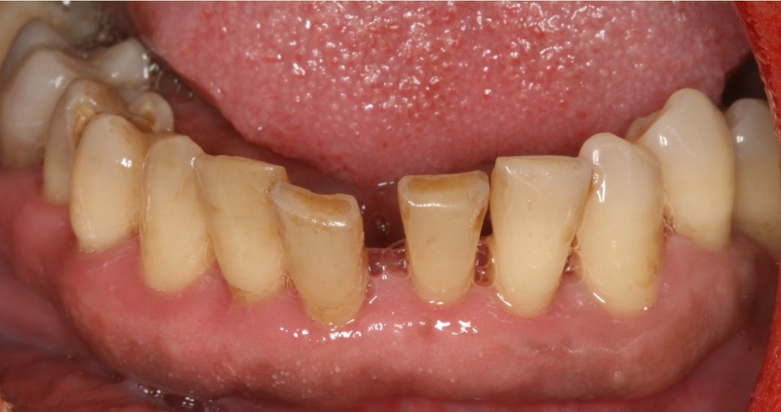 Περιοδοντίτιδα μετά τη θεραπεία