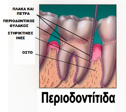 Αρχόμενη Περιοδοντίτιδα