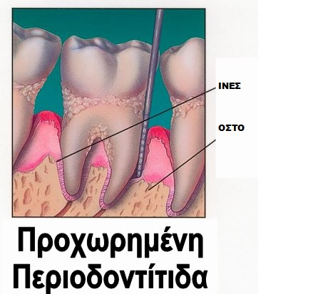 Προχωρημένη Περιοδοντίτιδα