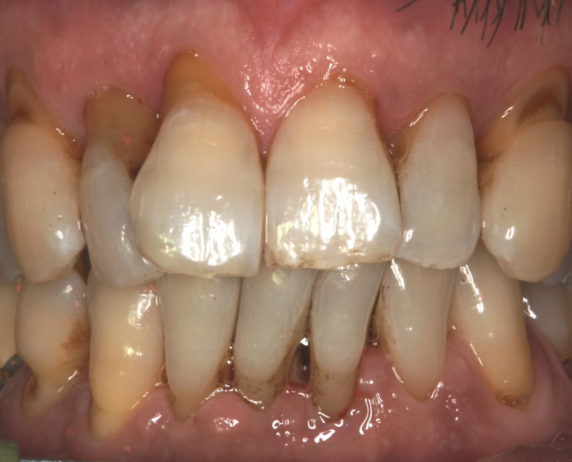 Υποχώρηση ούλου από περιοδοντίτιδα